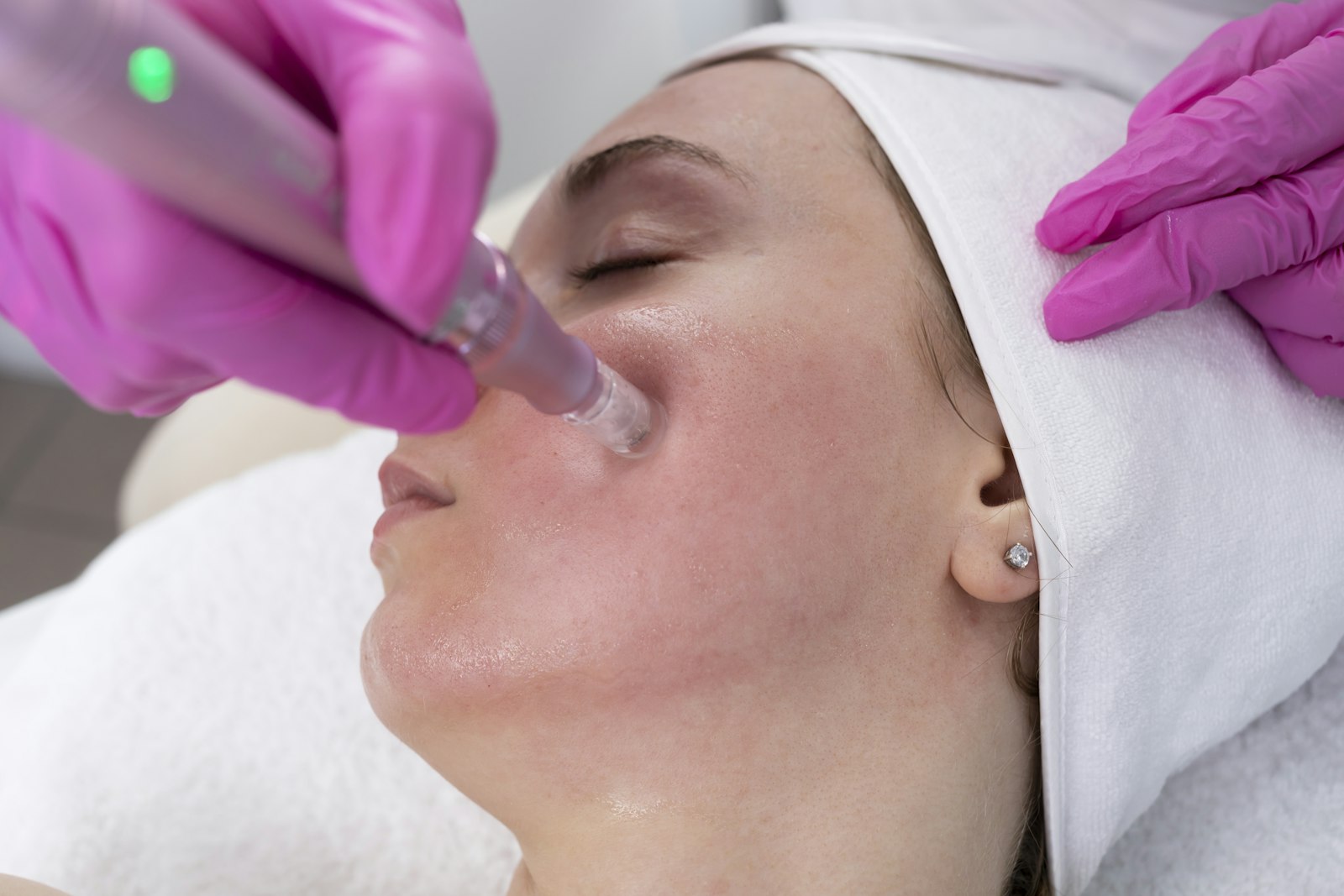 Tratamiento con Dermapen y cóctel de vitaminas