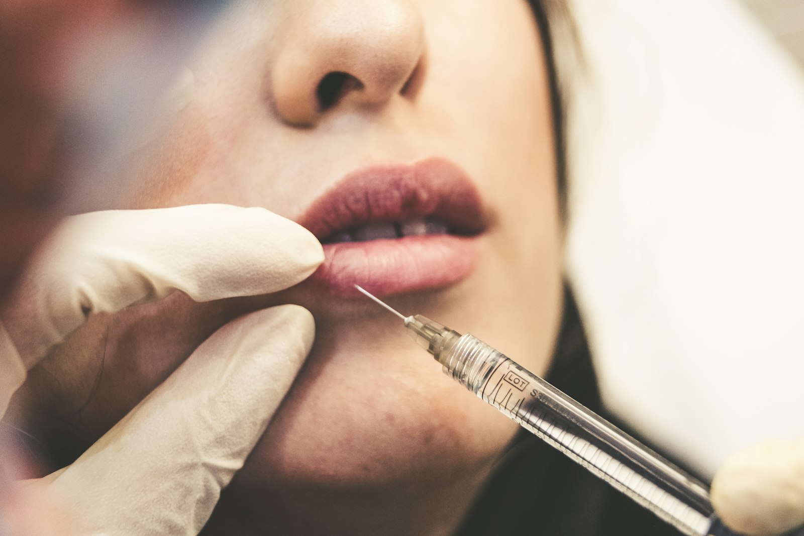 Relleno de labios con ácido hialurónico
